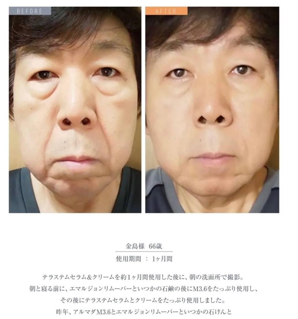 【青山スキンクリニック監修】ハリ・くすみ・透明感｜ヒト幹細胞培養上清液（5%）配合美容液 テラステム