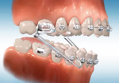 Jenis Behel Gigi- Global Estetik Dental Care