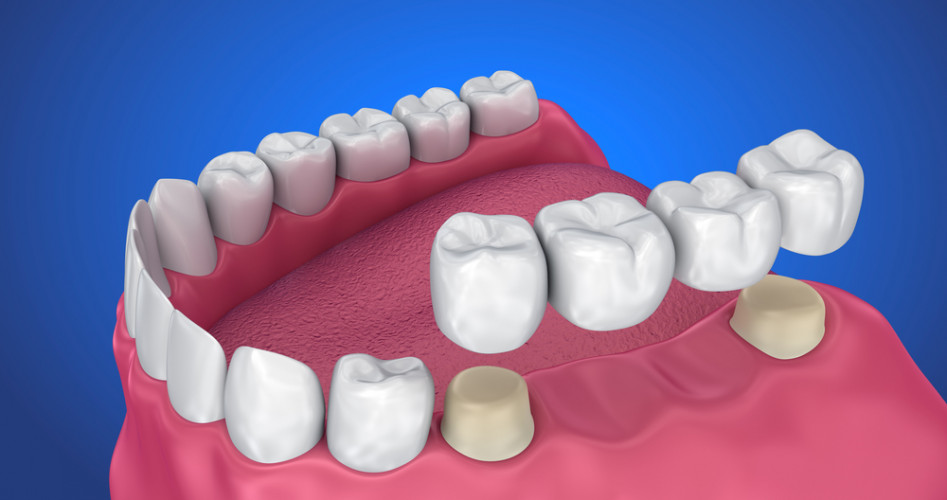 En cada arcada dentaria hay 16 dientes.