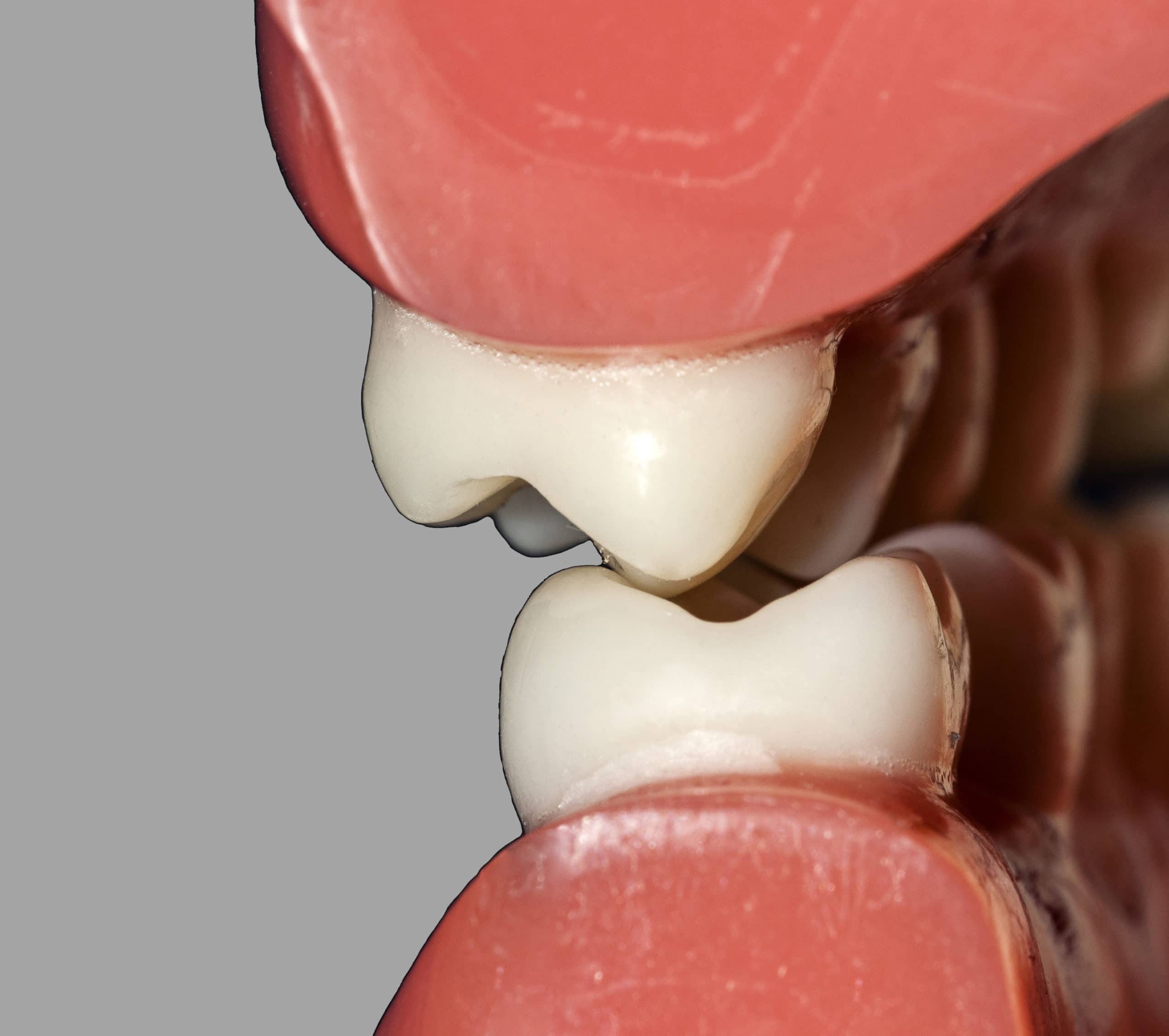 La oclusión dental es el engranaje de los diente