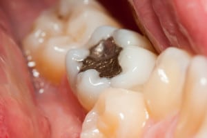 Cuando la caries es superficial, se suele hacer un empaste.