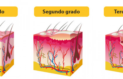 Tipos que quemadura según la profundidad