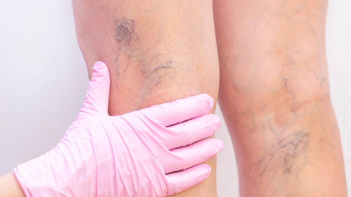 Pernas com veias vis&iacute;veis sendo examinadas por m&atilde;o enluvada de rosa.