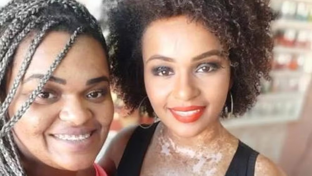 Natália Deodato e sua mãe, Daniela Rocha, que foi alvo de racismo no salão de beleza da família. Duas mulheres sorrindo: uma com tranças e aparelho, outra com cabelo crespo e vitiligo