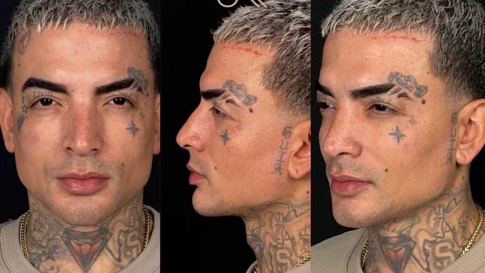 MC Guimê exibe os resultados da manutenção em sua harmonização facial, focando na naturalidade e refinamento Homem com cabelo loiro e tatuagens faciais em vistas frontal, perfil e três-quartos