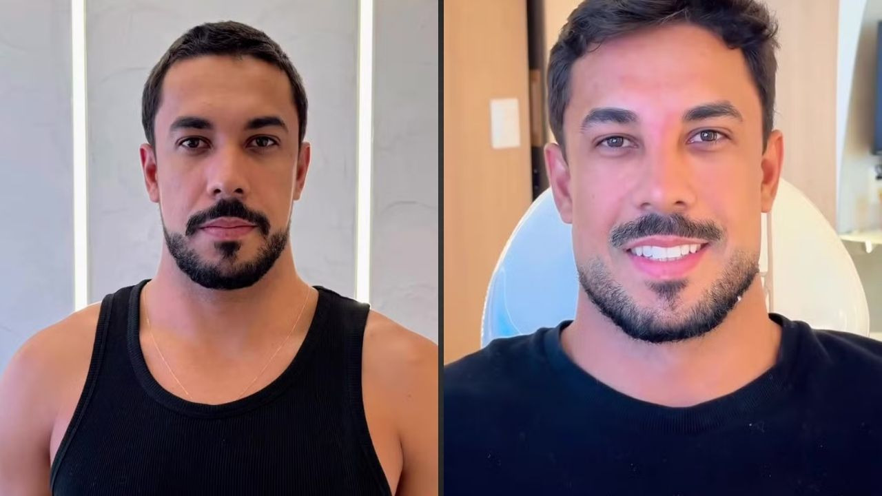 Maike Allan, ex-BBB 25, exibe o antes e depois de sua harmonização facial, celebrando o novo visual - Foto: Reprodução/Instagram Maike Allan, ex-BBB, antes (sério) e depois (sorrindo) da harmonização facial