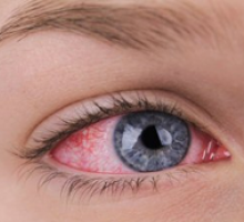 Herpes ocular: períodos de estresse intenso favorecem a doença