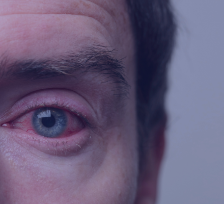 Curiosidade: Por que os olhos incham quando choramos?