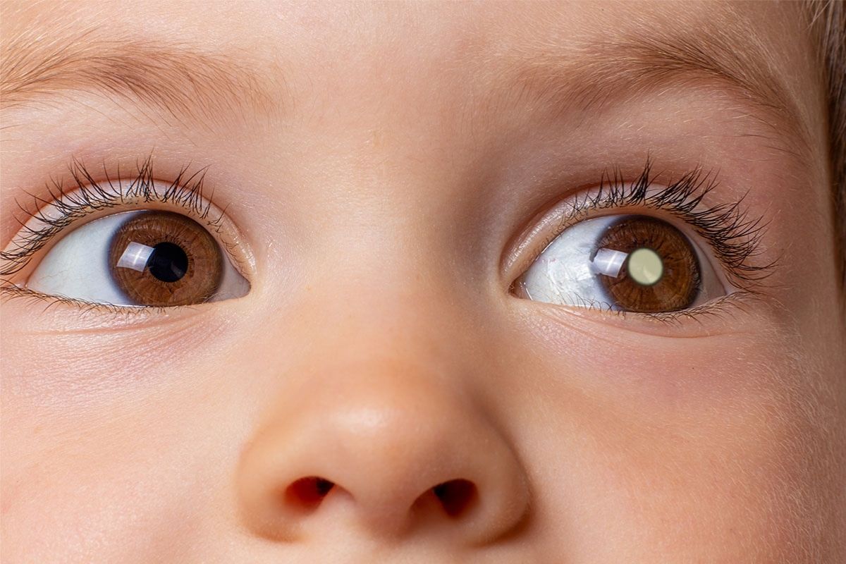 O que é retinoblastoma? 