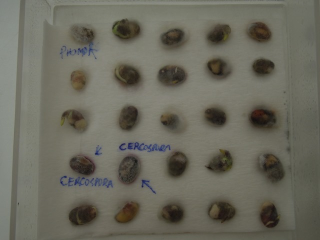 Mancha púrpura ou crestamento foliar de cercospora, facilmente identificada pela coloração púrpura das sementes