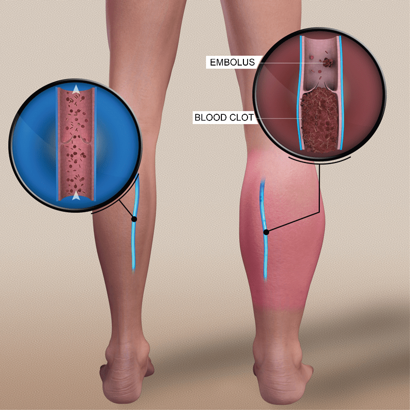 Venous Thromboembolism Community