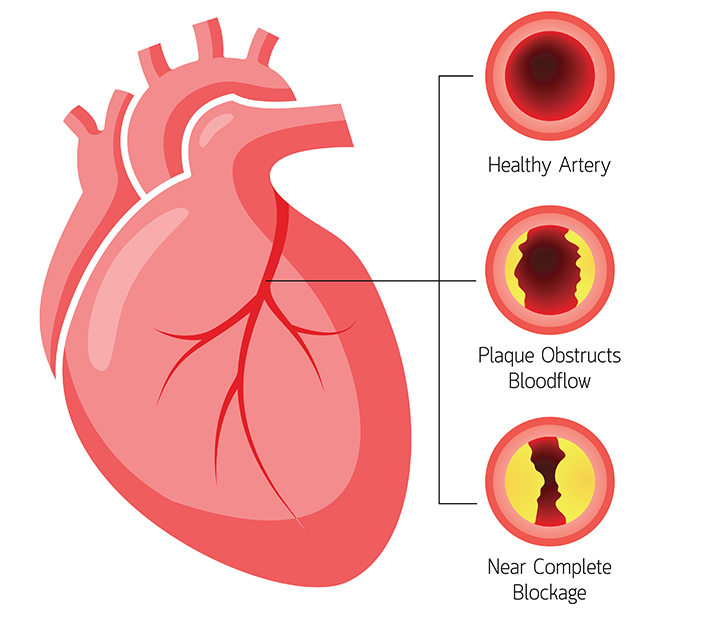 Coronary Artery Disease Community