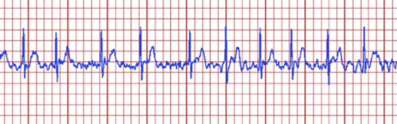 Atrial Fibrillation 