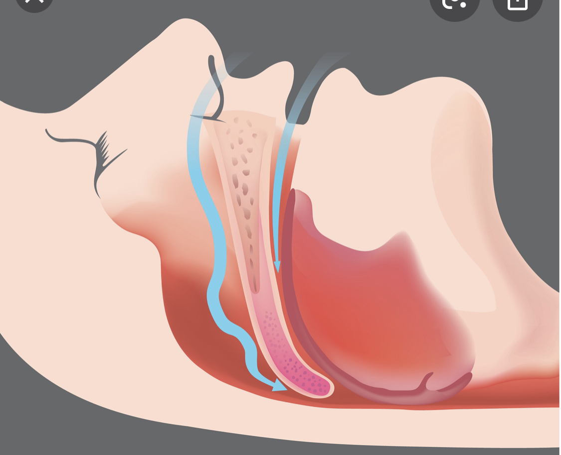 Obstructive Sleep Apnea