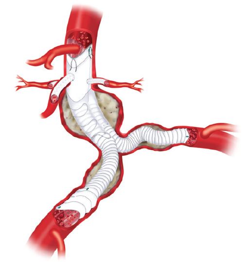 Complex Aneurysm Repair Community