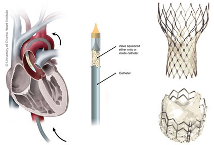 TAVI/ TAVR community