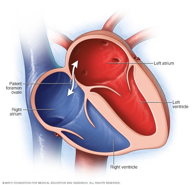 PFO/ cryptogenic stroke