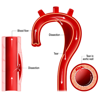 Aortopathy - find out more about aortic disease