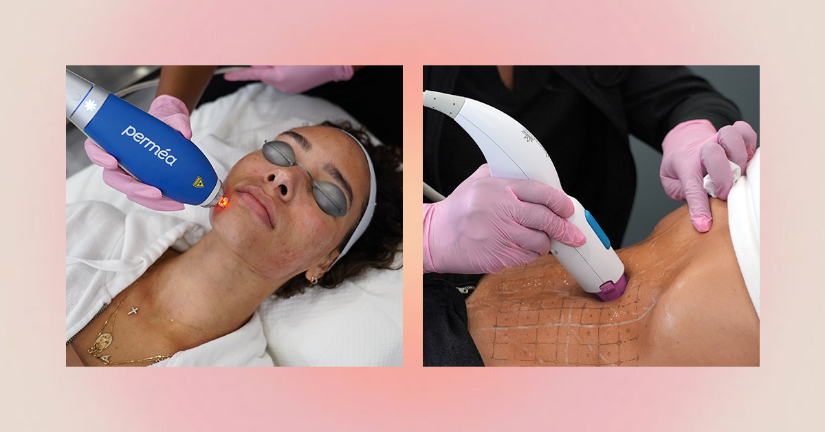 Laser away article image for 4 Common Postpartum Skin Struggles — and How to Fix Them