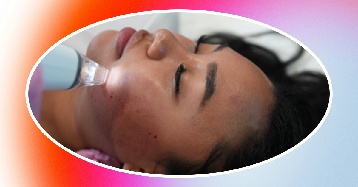 Laser away article image for How Long Does It Take to See Results From RF Microneedling?