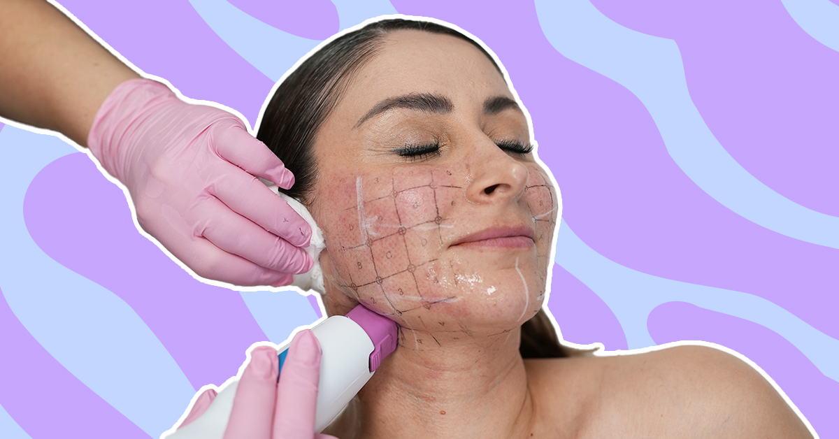 Laser away article image for Treatment Diary: I Tried Thermage on My Chin and Neck