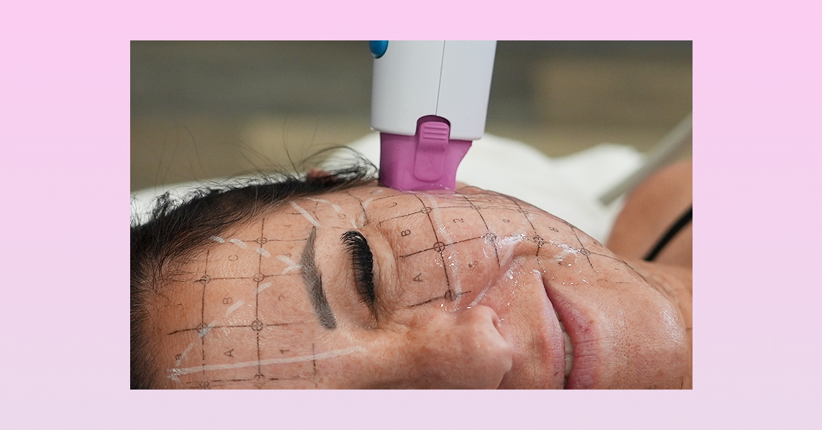 Laser away post image for What Is Thermage? Here’s Everything You Need To Know