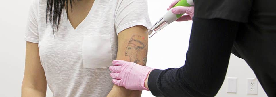 Laser away post image for How To Prepare For Laser Tattoo Removal