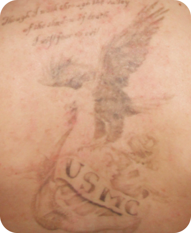 Tattoo Removal - Before & After Pictures of Our Patients at VIVAA