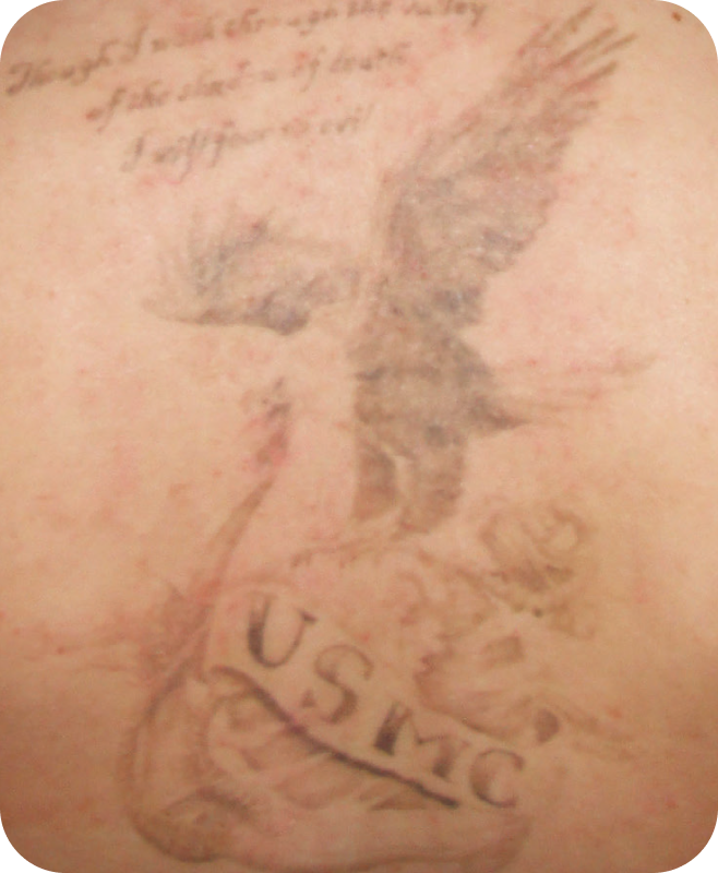 Laser Tattoo Removal