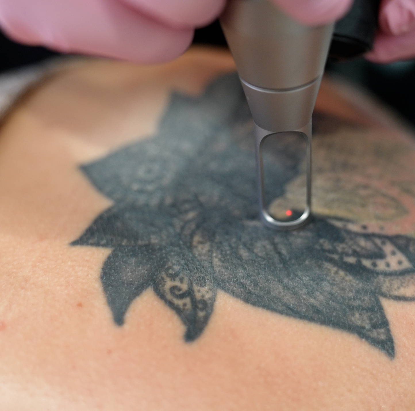 Laser Tattoo Removal