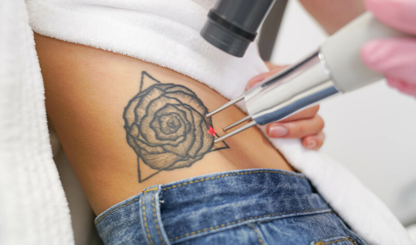 Laser away faq image for How Do Lasers Remove Tattoos?