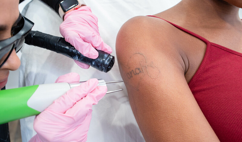 Laser away faq image for Is Laser Tattoo Removal 100% Safe?