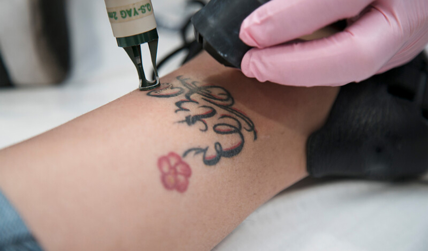 Laser away article image for Tattoo Removal Laser Differences