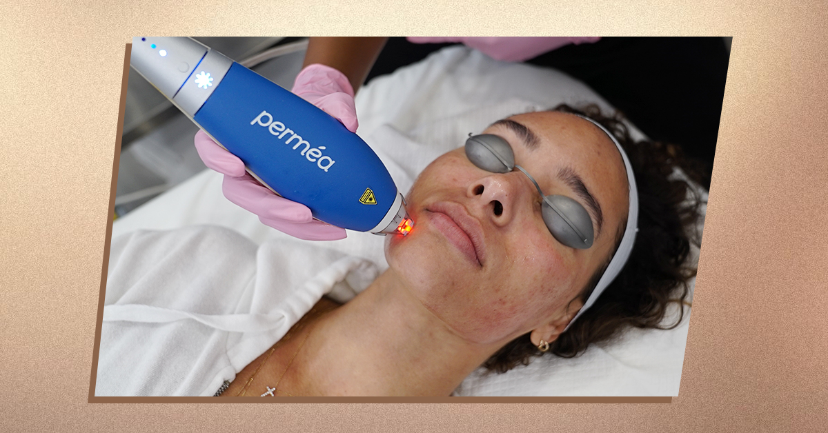 Laser away article image for What is The Best Laser Treatment for Hyperpigmentation?