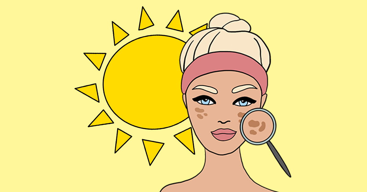 Laser away post image for How to Treat Hyperpigmentation Caused by Sun Exposure