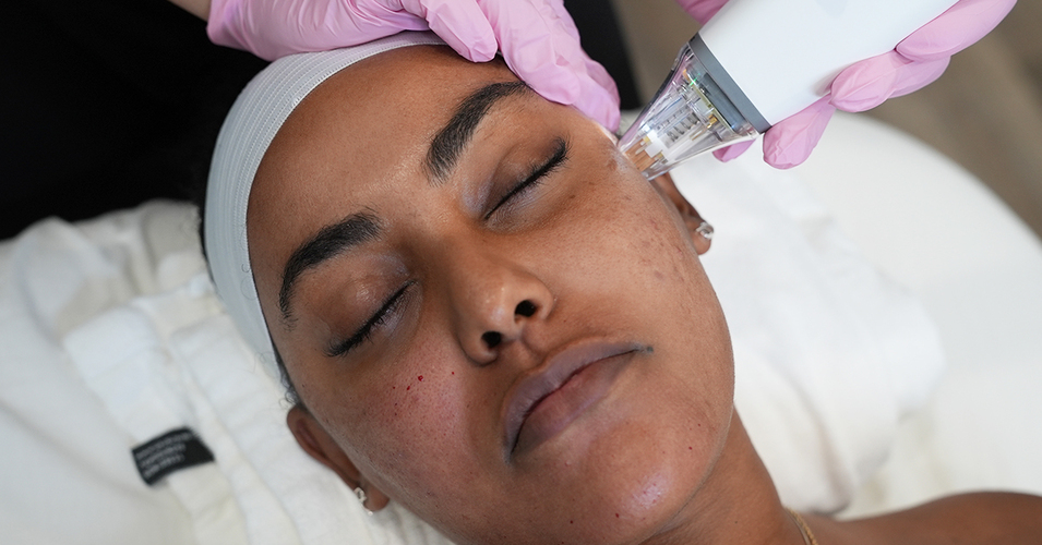Laser away faq image for Does Potenza RF Microneedling hurt?