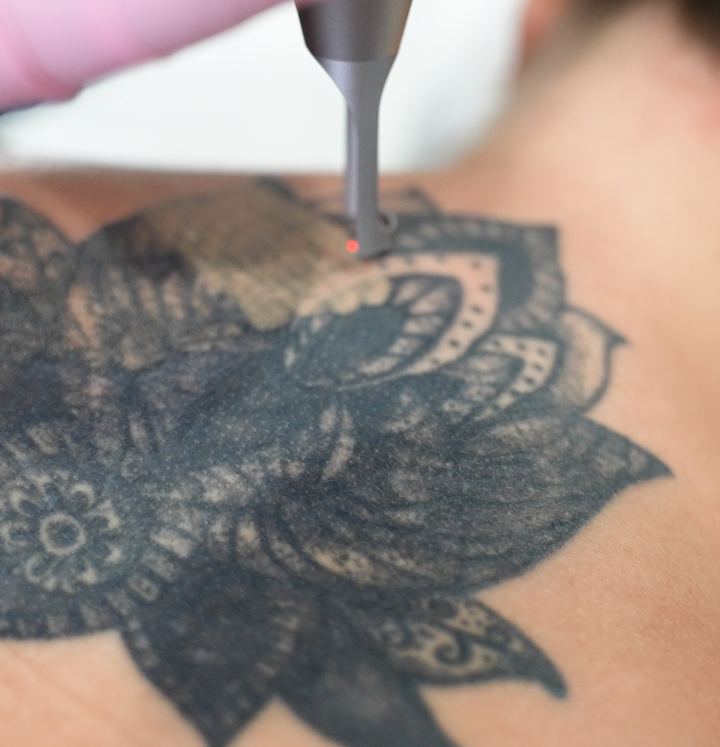 How Many Treatments Does It Take Before The Tattoo Is Removed?