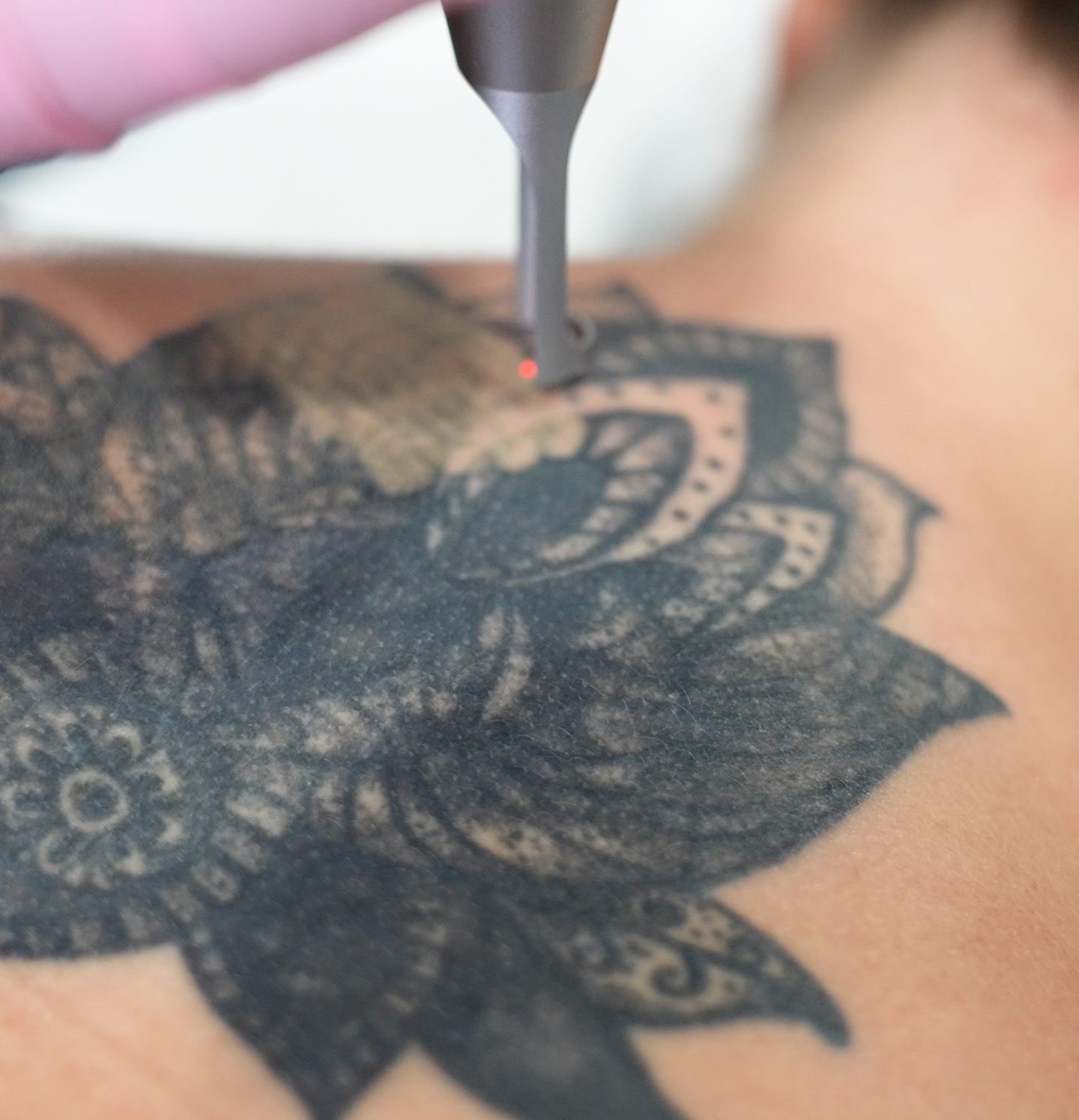 What Should I Do For Laser Tattoo Removal Aftercare?