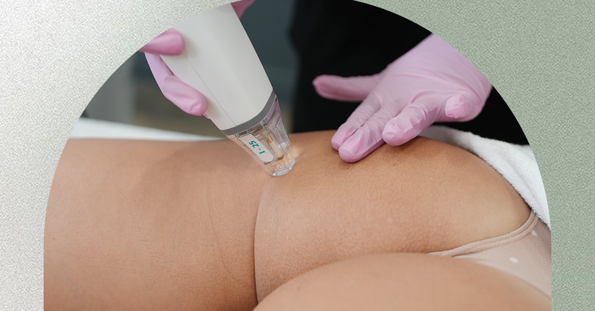 Laser away post image for Does RF Microneedling Reduce Cellulite?