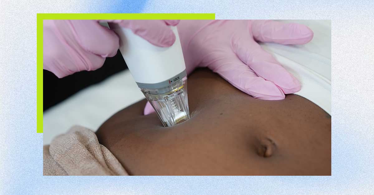 Laser away post image for How Does RF Microneedling for Stretch Marks Work?