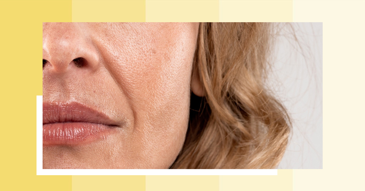 Laser away post image for How Can I Get Rid of Nasolabial Folds?