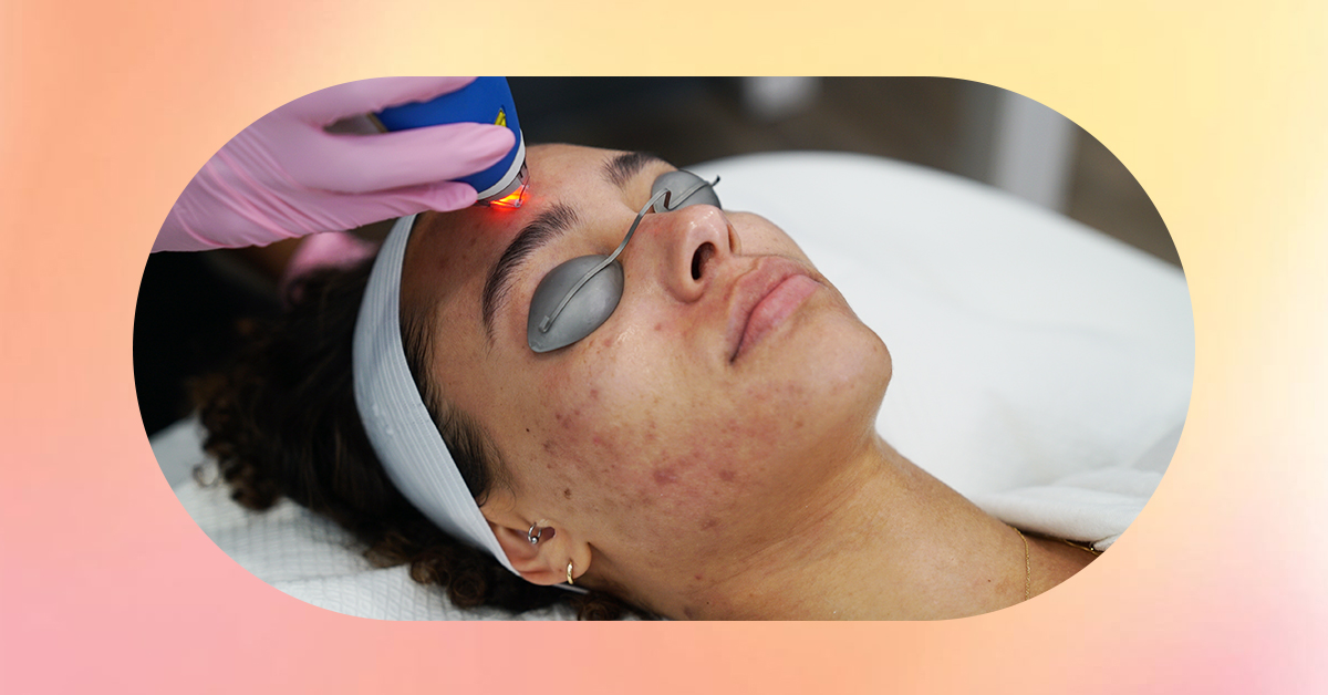Laser away post image for How to Address Hyperpigmentation From Laser Hair Removal