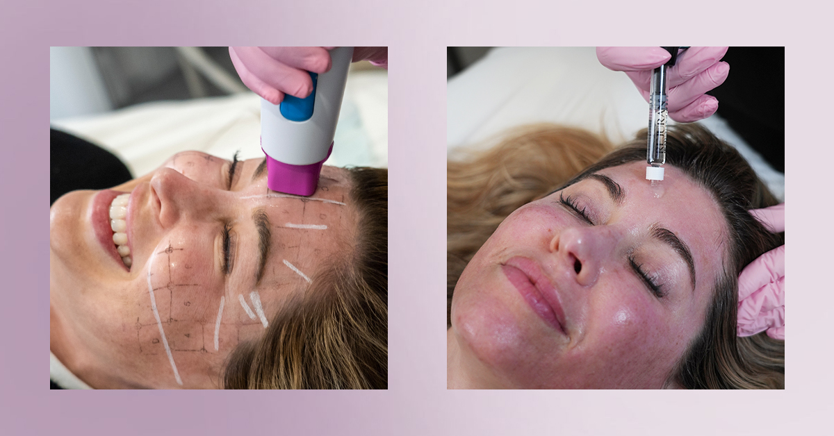 Laser away article image for What Is Prejuvenation? What It Means And Why Thermage Can Help