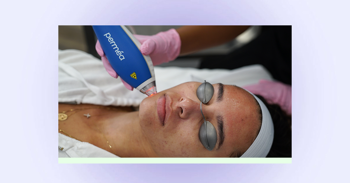 Laser away article image for Acne Scar Fading Timeline: What You Need to Know