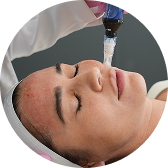 LaserAway service image for SKINPEN® MICRONEEDLING
