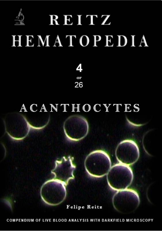 Acanthocytes