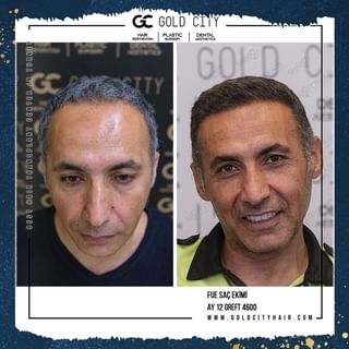 One of the top publications of @goldcityhairtransplant which has 38 likes and 1 comments