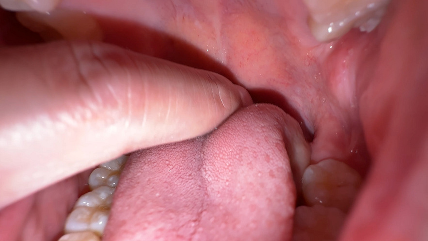 【個人撮影】渡来ふうの喉チン触り＆開口器アヘ顔Wピース