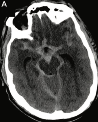 Figura 2: TC de Crânio que apresenta uma Hemorragia Subaracnoide
