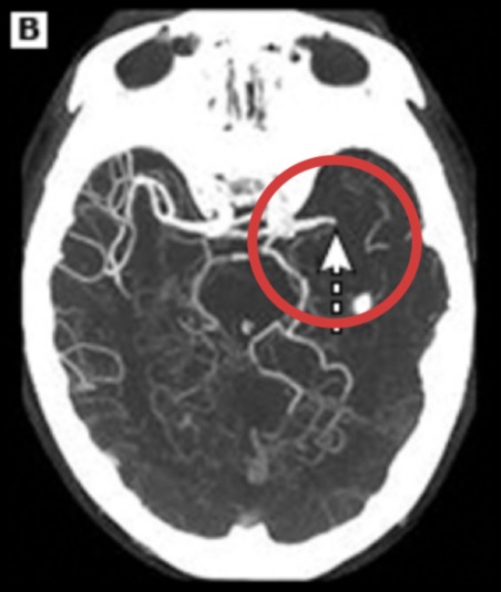 Artéria cerebral média hiperdensa, sintoma insuficiente para decidir por uma trombectomia mecânica